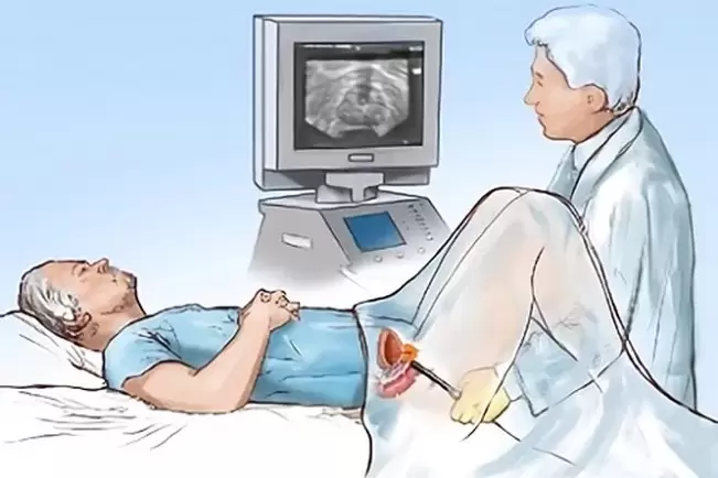 diagnostic de prostatite
